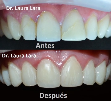 Resultados de estética dental realizada por Laura Lara