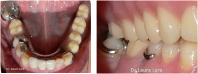 Prótesis Dental Removible realizada por la doctora Laura Lara
