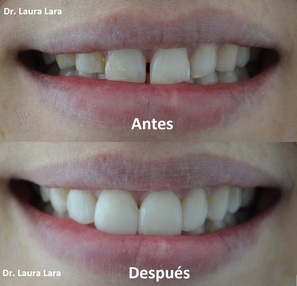 Fotos de antes y después de un Diseño de Sonrisa realizado por Laura Lara