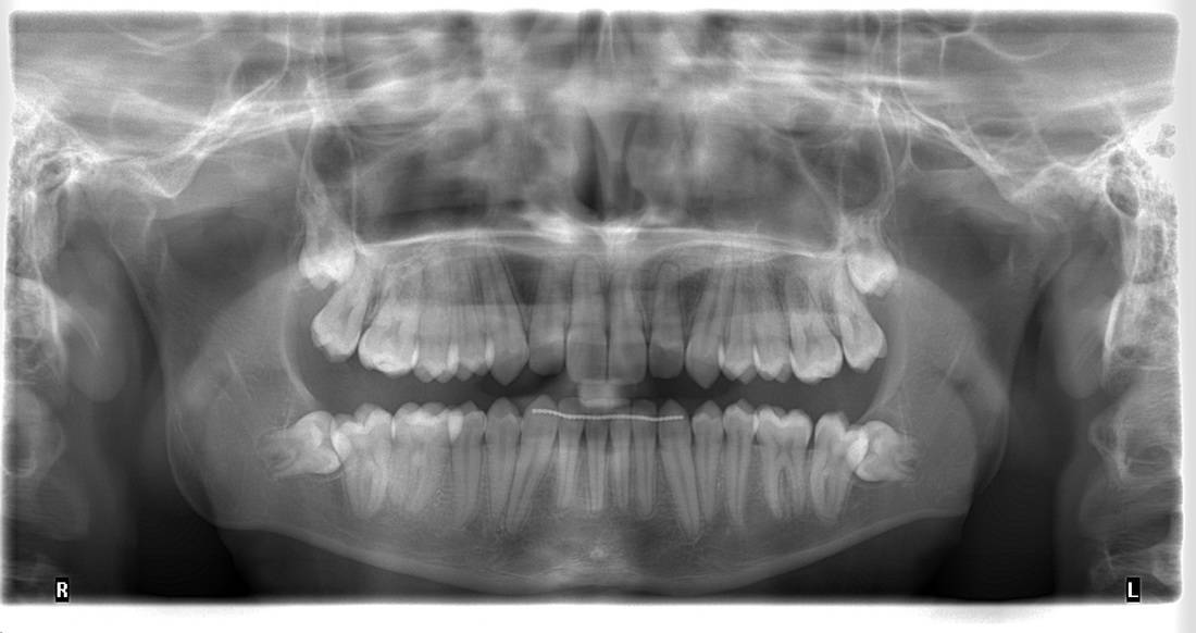 Cirugía Oral , cordales, exodoncias, cirugia, extraer diente, biopsia, implantes