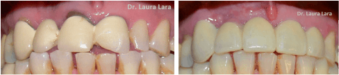 Prótesis Dental Fija , coronas dentales paciente de la doctora Laura Lara