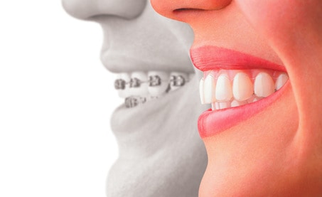 Ortodoncia , ortodoncia invisible, ortodoncia lingual, bracketsrealizada por la especialista Viviana Forero aliada de la odontolog Laura Lara